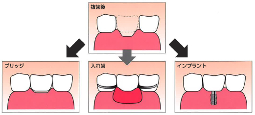 むし歯の治療法（C4）