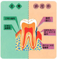 こんなに怖い歯周病