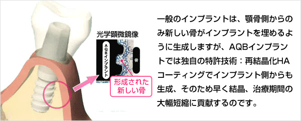 当院のインプラント治療のご紹介