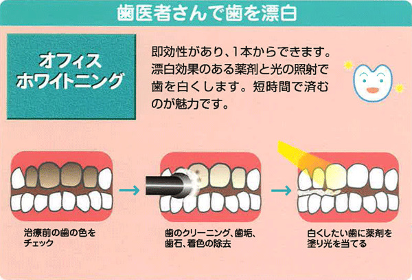 ホワイトニングの主な種類と方法